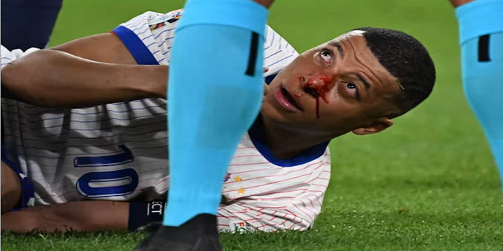 Cầu thủ Mbappe dính chấn thương nghiêm trọng ở mặt